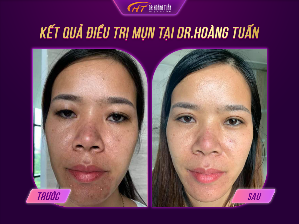 trị mụn bằng laser có tốt không